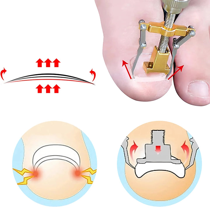 Professional Ingrown Toenail Treatment Set with Correction Patches and Pedicure Tools